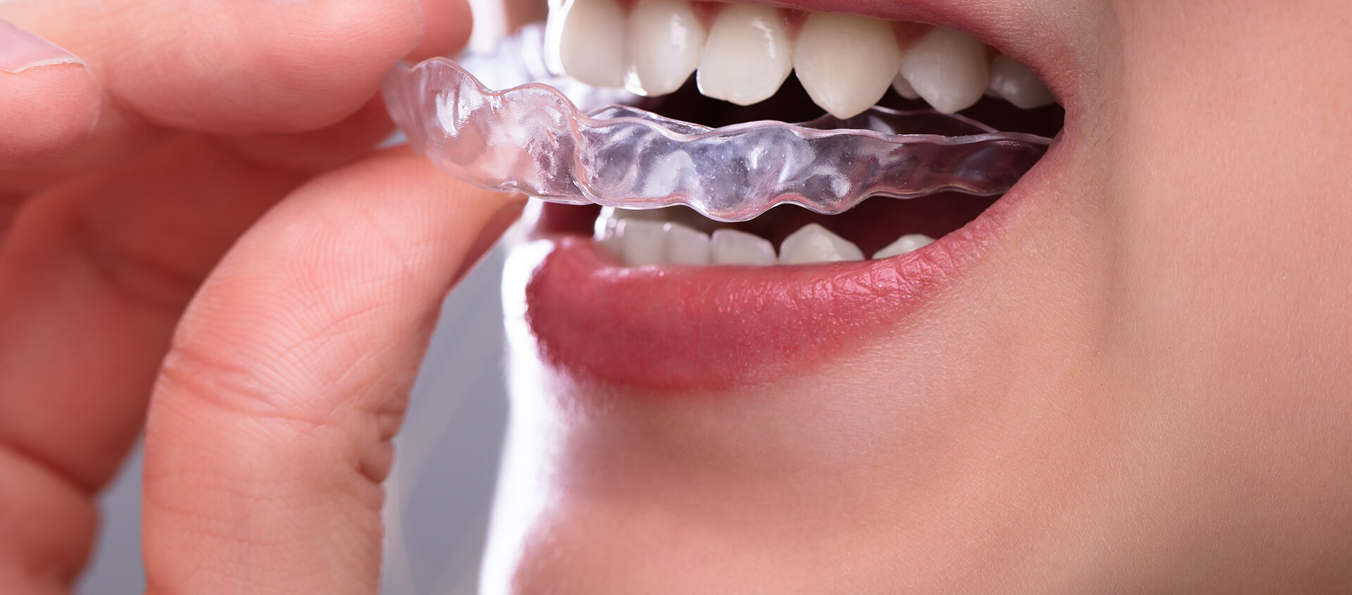 Suresmile Clear Aligners in Anderson IN Area